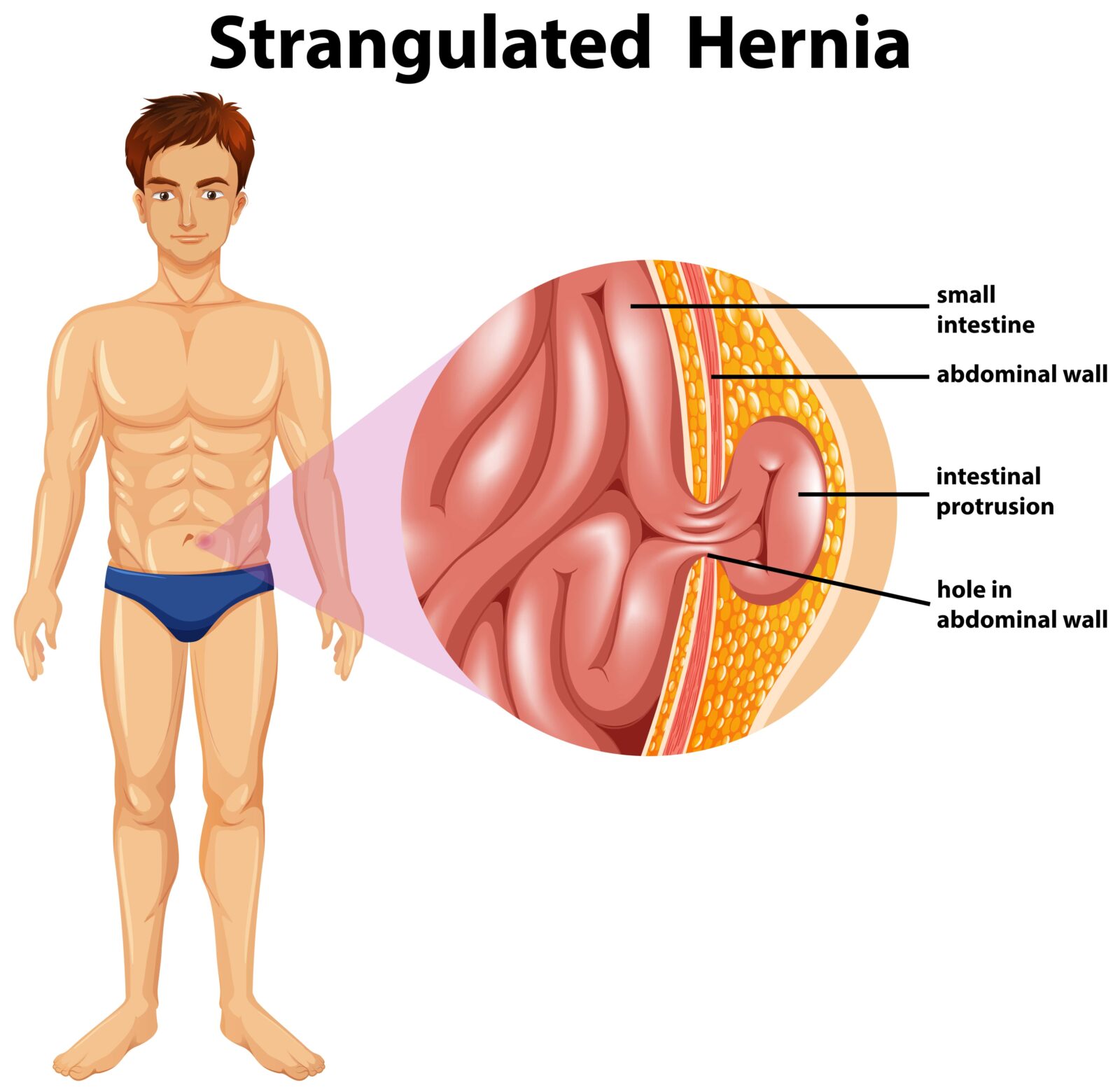 strangulated hernia
