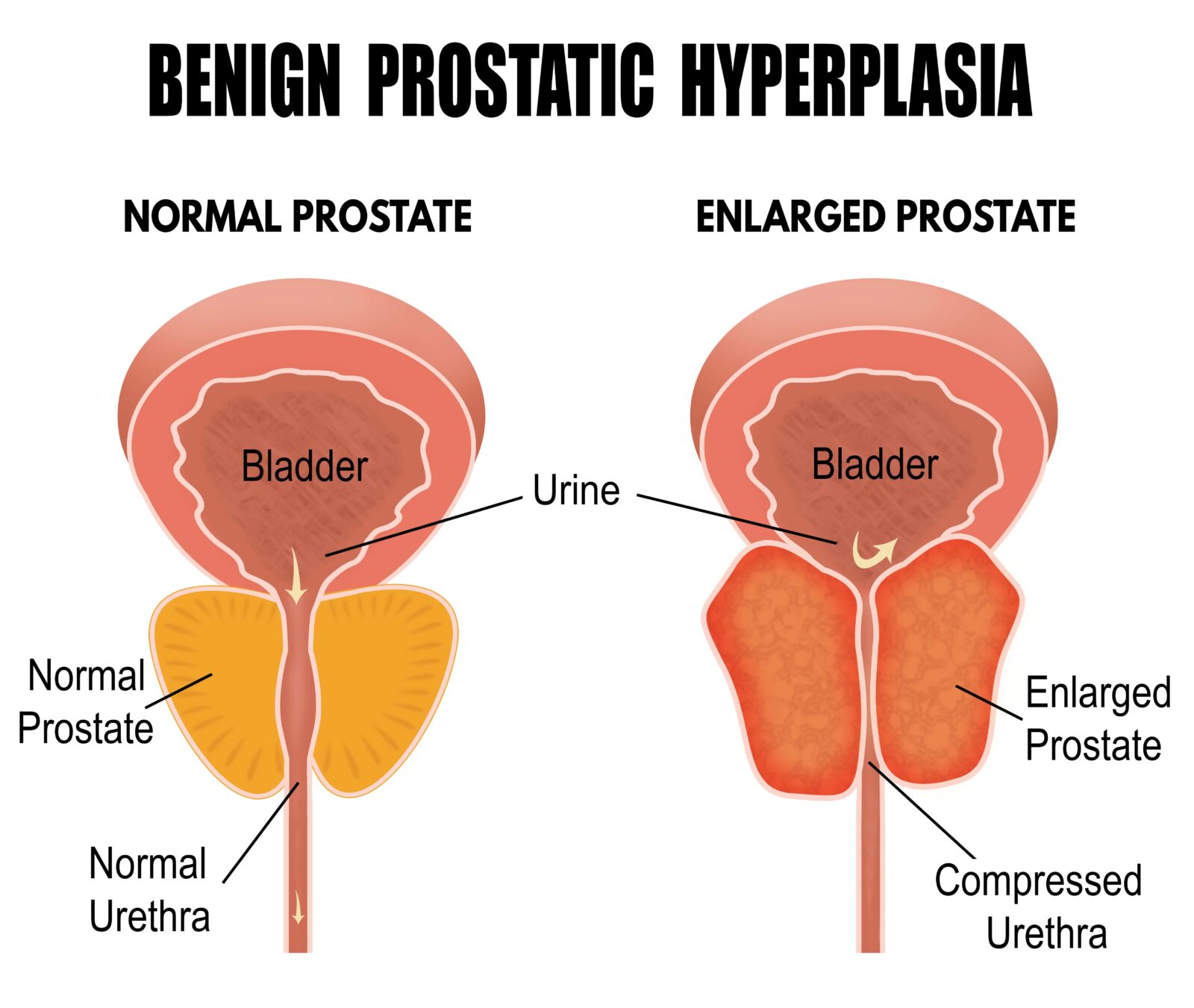 healthy vs enlarged prostate