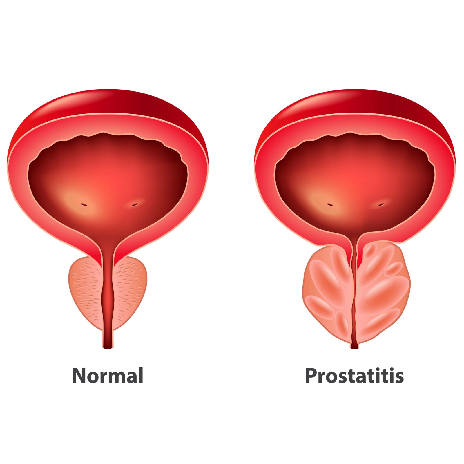 normal prostate vs. prostatitis