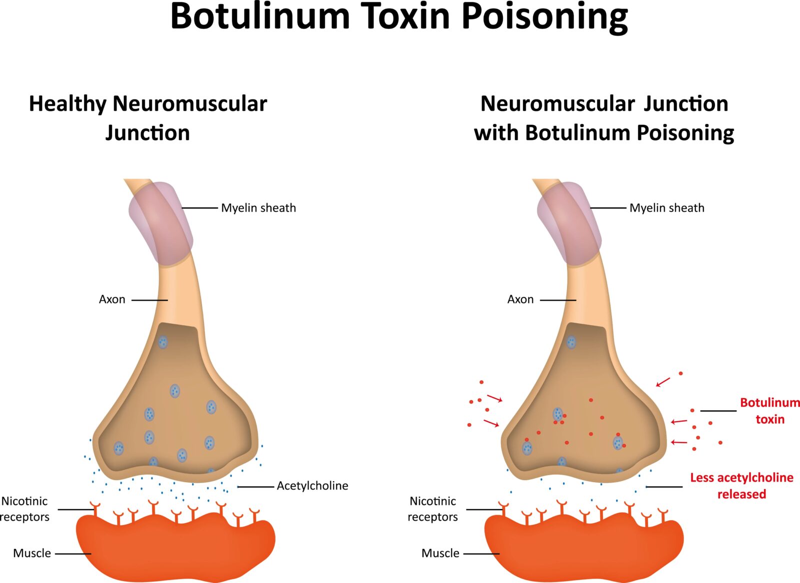 Botox poisoning for hyperhidrosis treatment